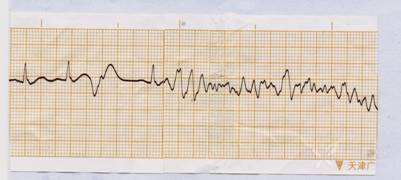 尖端扭轉型室速與室顫的心電圖鑑別