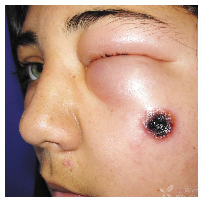 扩大并发展出中央囊泡,囊泡破裂后留下一个无痛的坏死溃疡与黑色焦痂