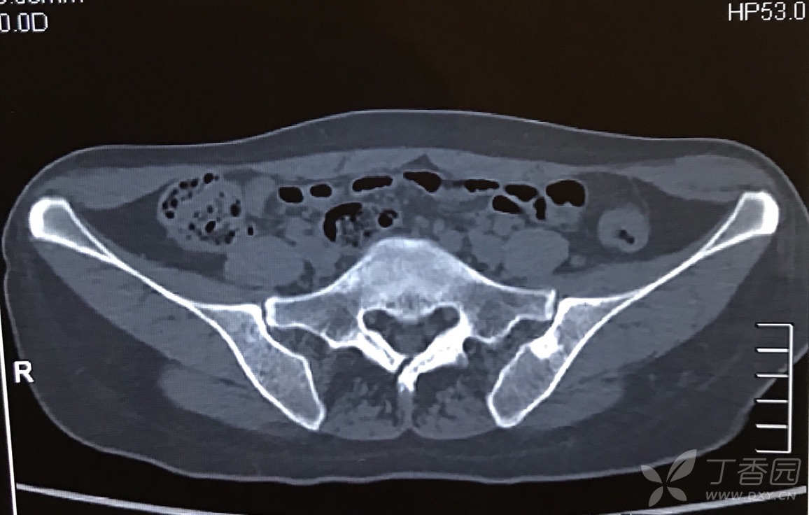 各位大师请判断,骨岛?骨纤?转移瘤?如何进行下一步?