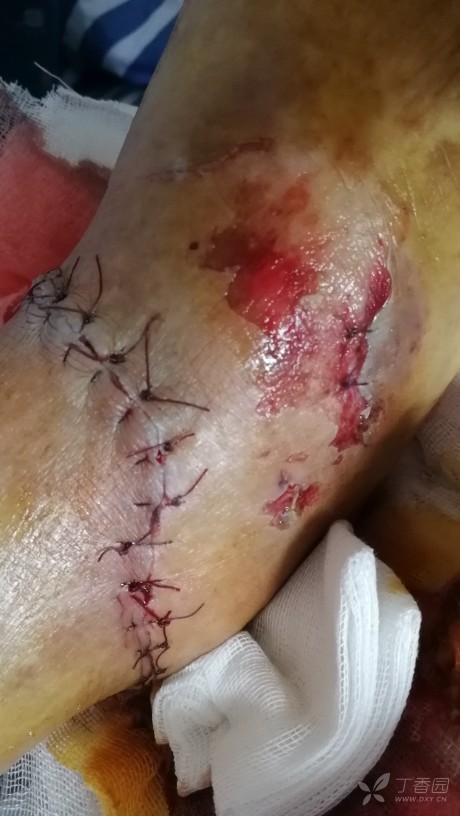 清创后出现边缘坏死