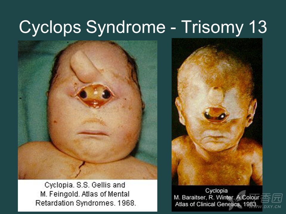 三体综合症小孩图片图片