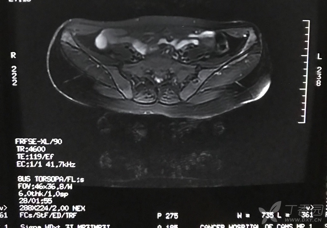 各位大师请判断,骨岛?骨纤?转移瘤?如何进行下一步?
