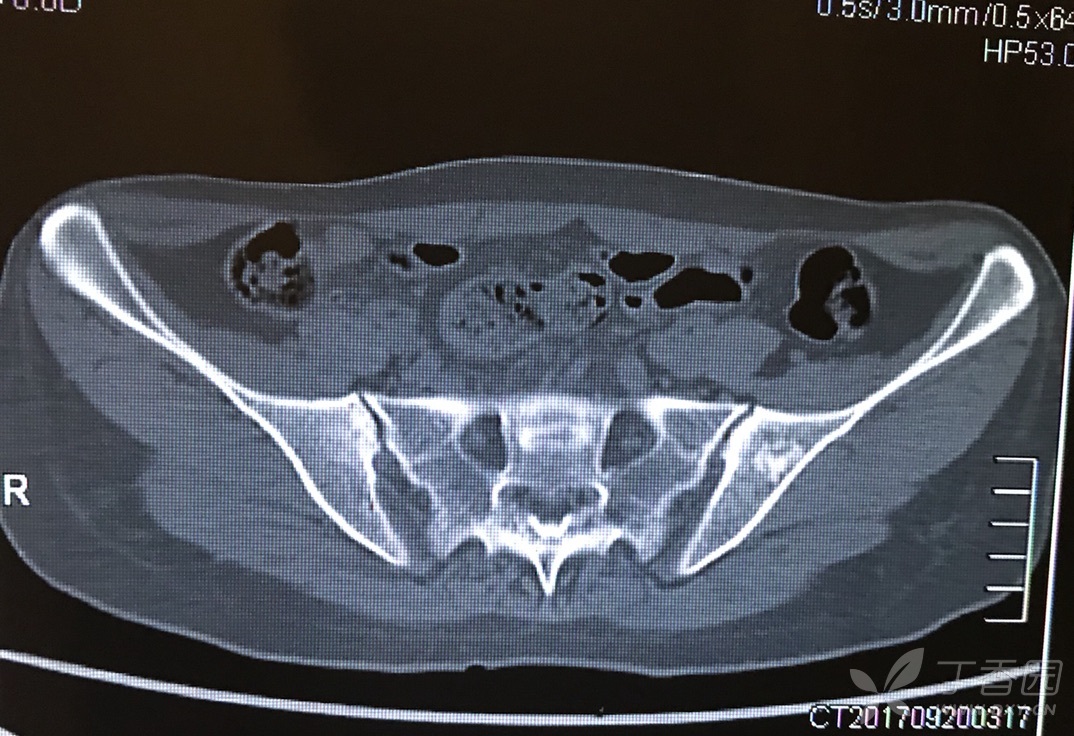 各位大师请判断,骨岛?骨纤?转移瘤?如何进行下一步?