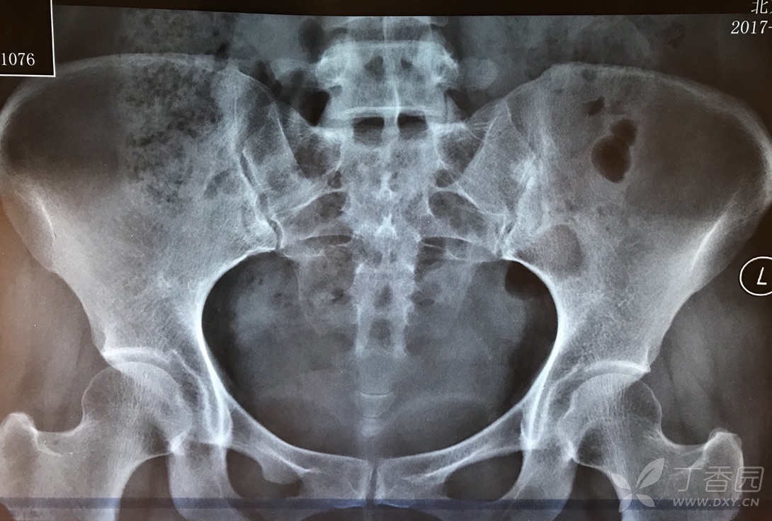 各位大师请判断,骨岛?骨纤?转移瘤?如何进行下一步?