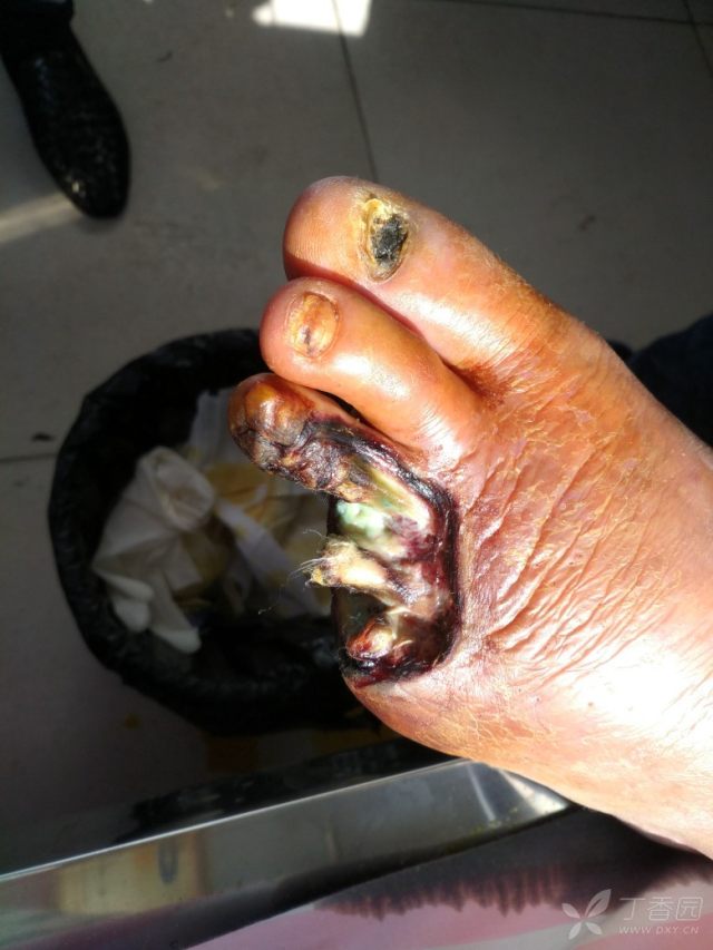 这样坏死感染的伤口目前如何处理 [病例帖]
