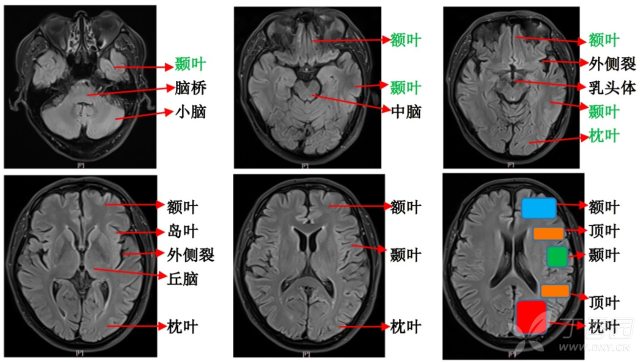 小脑幕影像解剖图图片