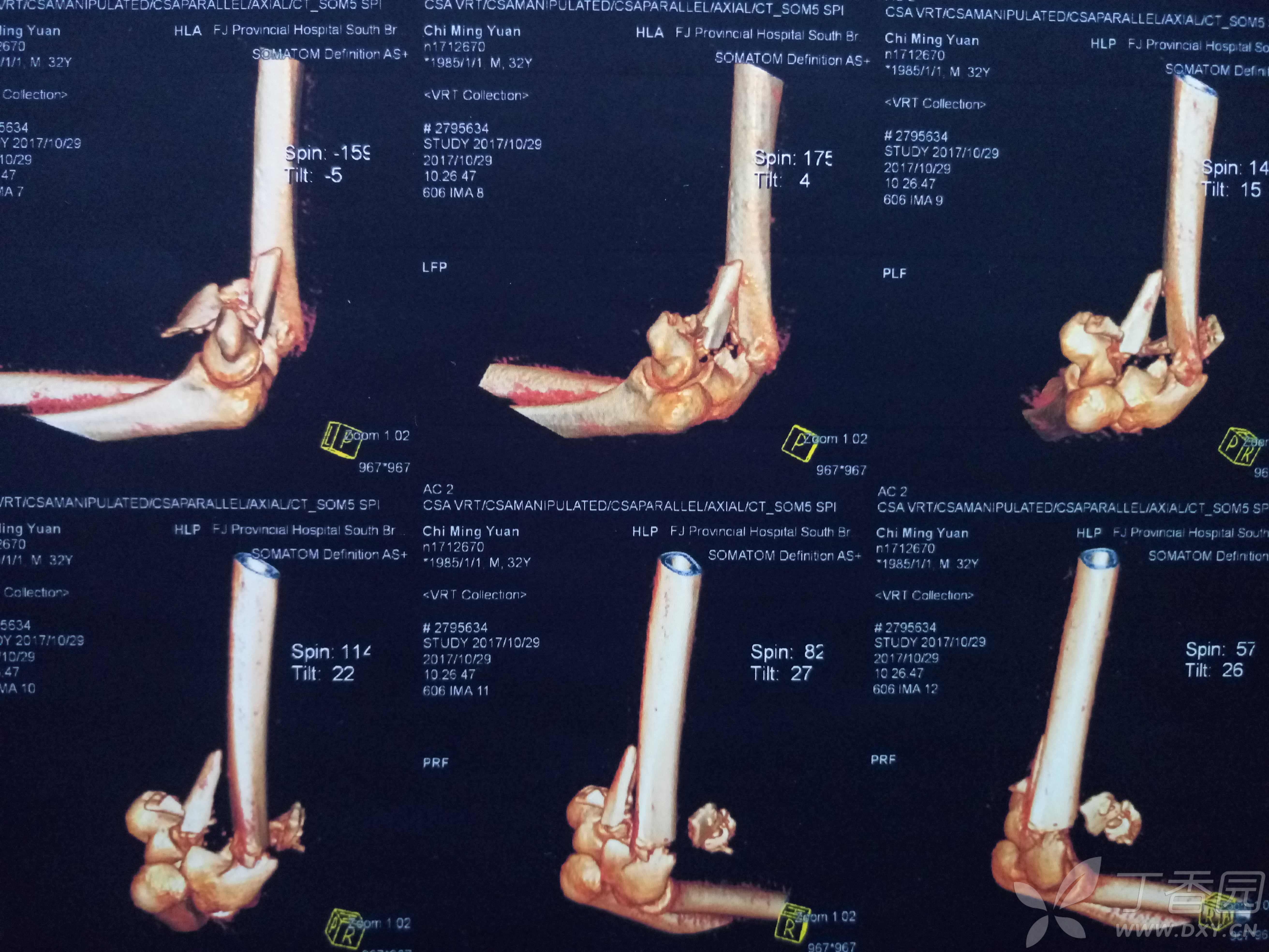 肱骨髁间粉碎性骨折图片