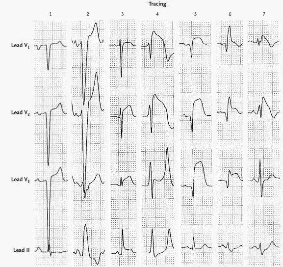 stt抬高一定是心梗吗,这个心电图你怎么看?
