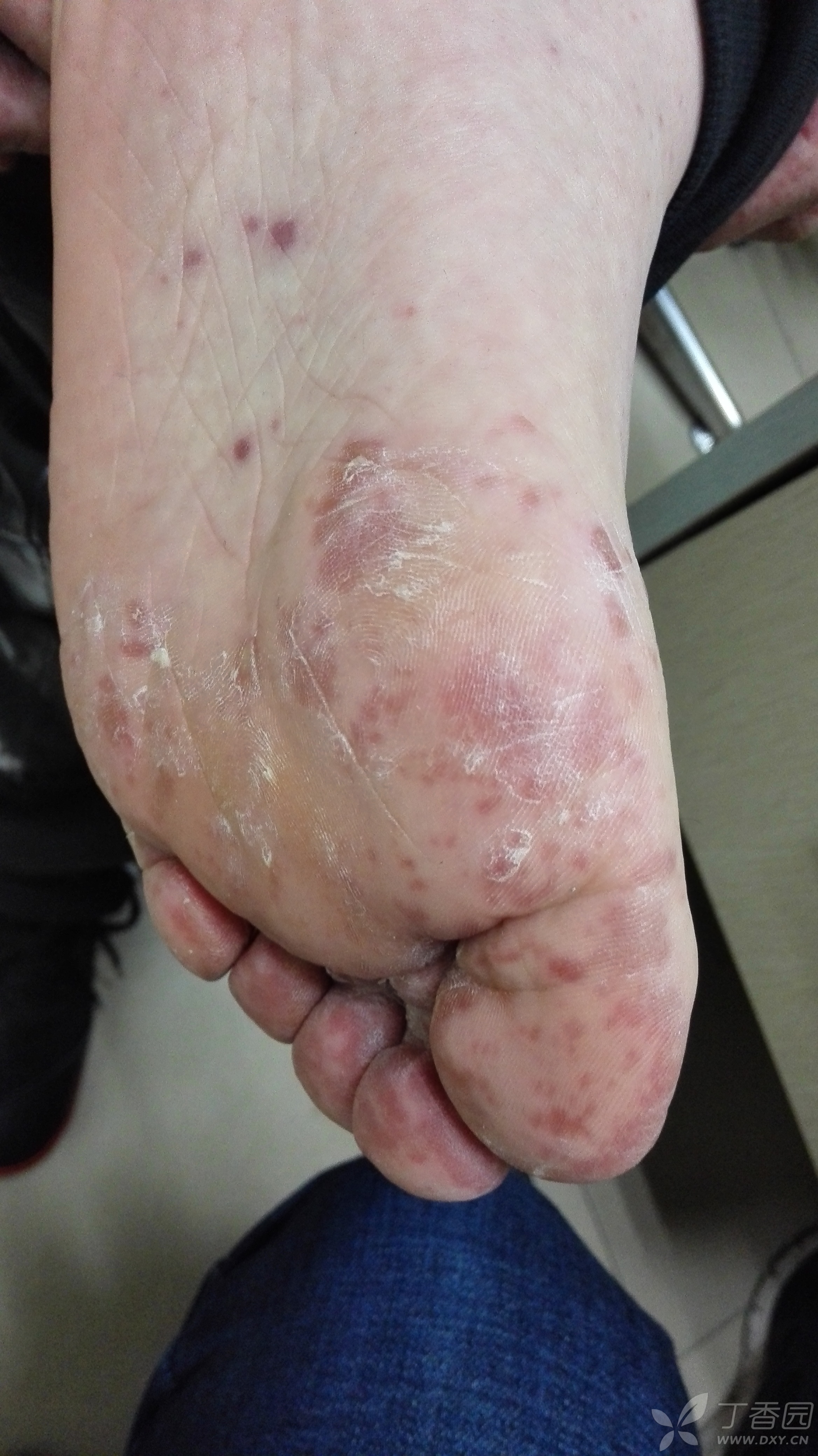 严重手足口病 - 皮肤与性传播疾病讨论版 -丁香园论坛