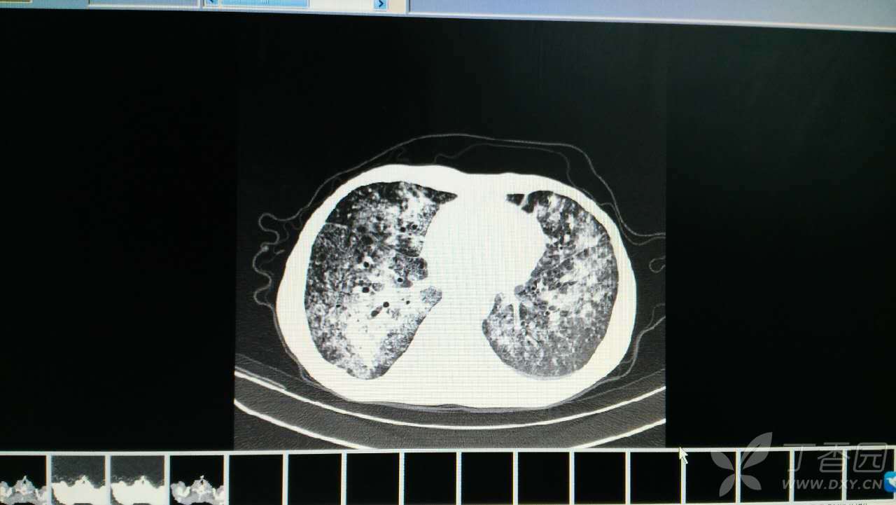血行播散肺结核图片图片
