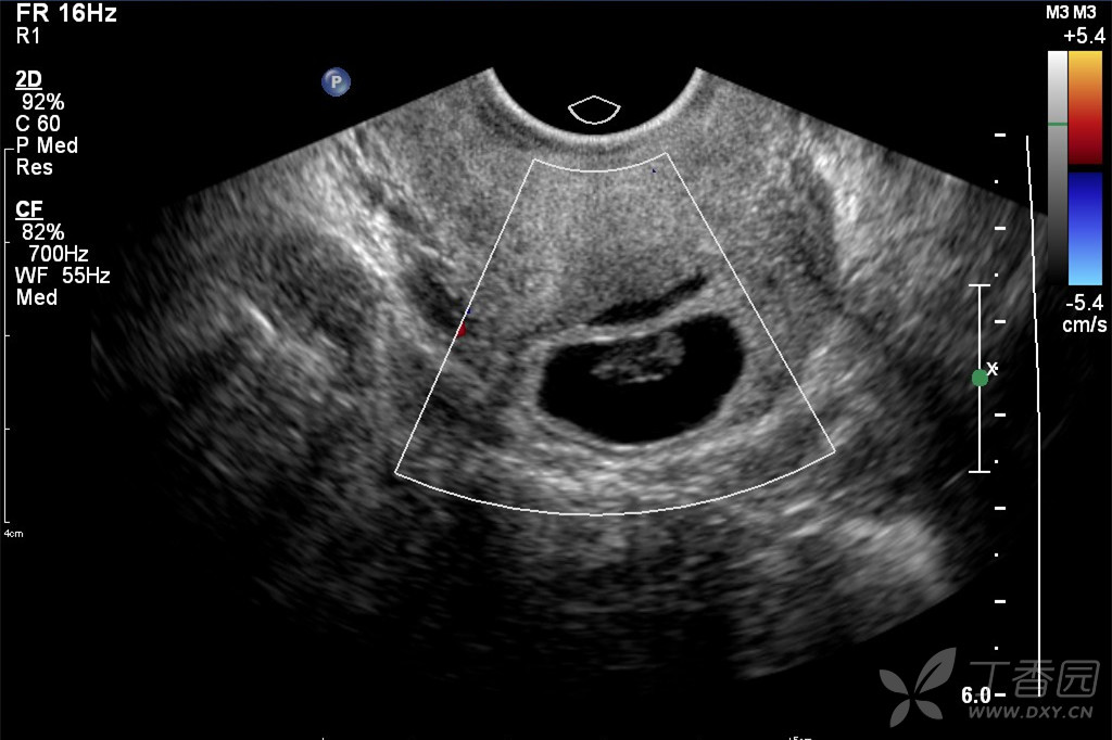 分享一例子宫瘢痕妊娠 超声医学讨论版-丁香园论坛