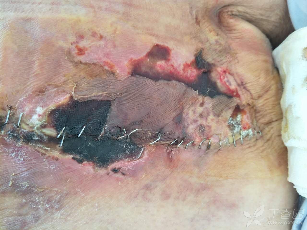 乳腺癌橘皮组织图片