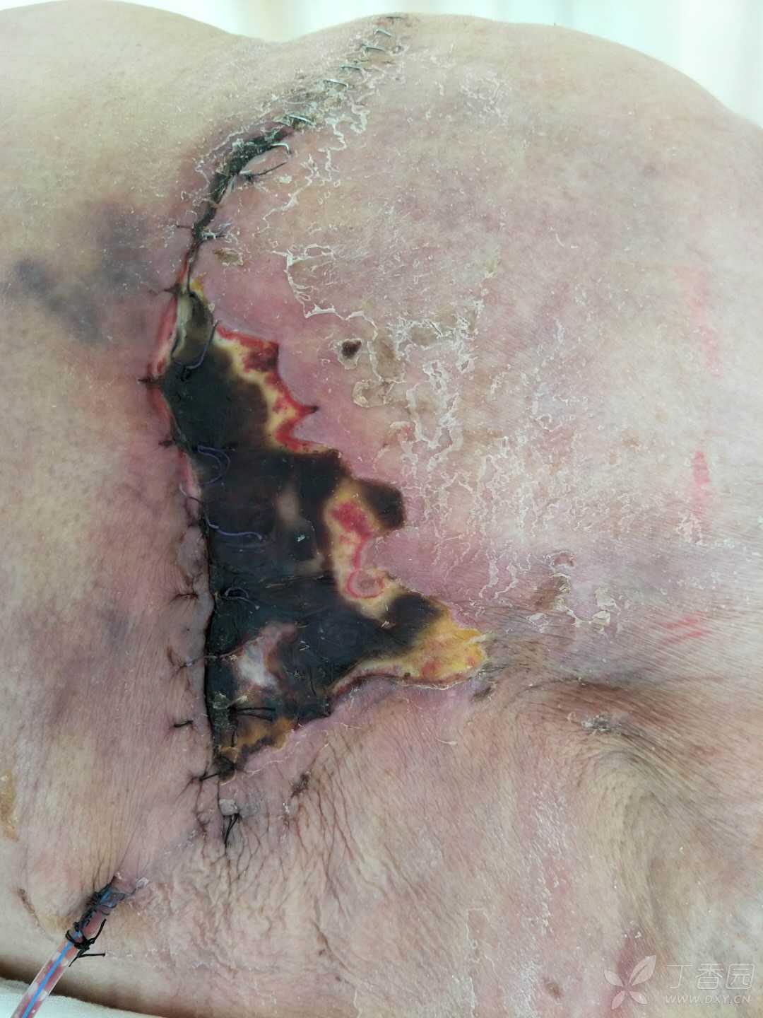 乳腺癌全切术后图片图片