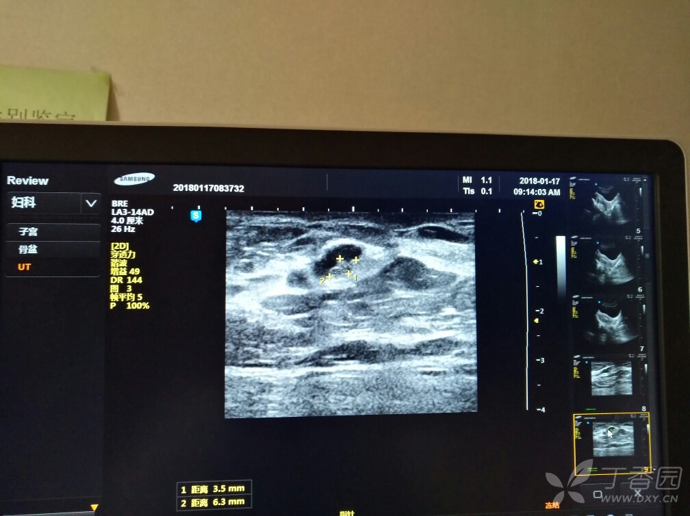 乳腺导管内异常回声