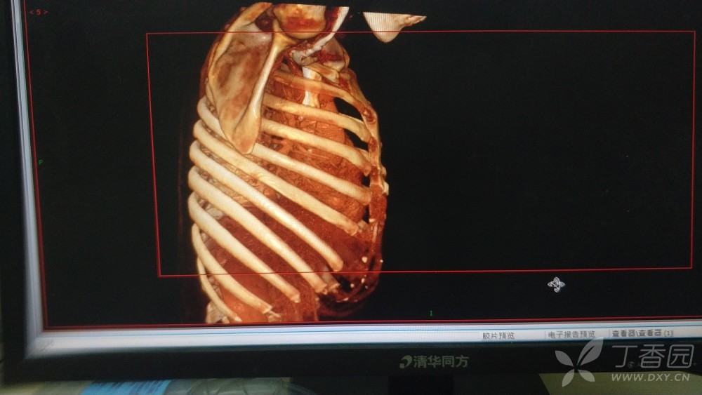 这个骨质破坏在哪里 右侧第六肋骨 骨科 丁香园论坛