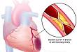 JAMA 子刊发表蒋立新团队文章：冠脉狭窄程度判读的准确性应引发关注