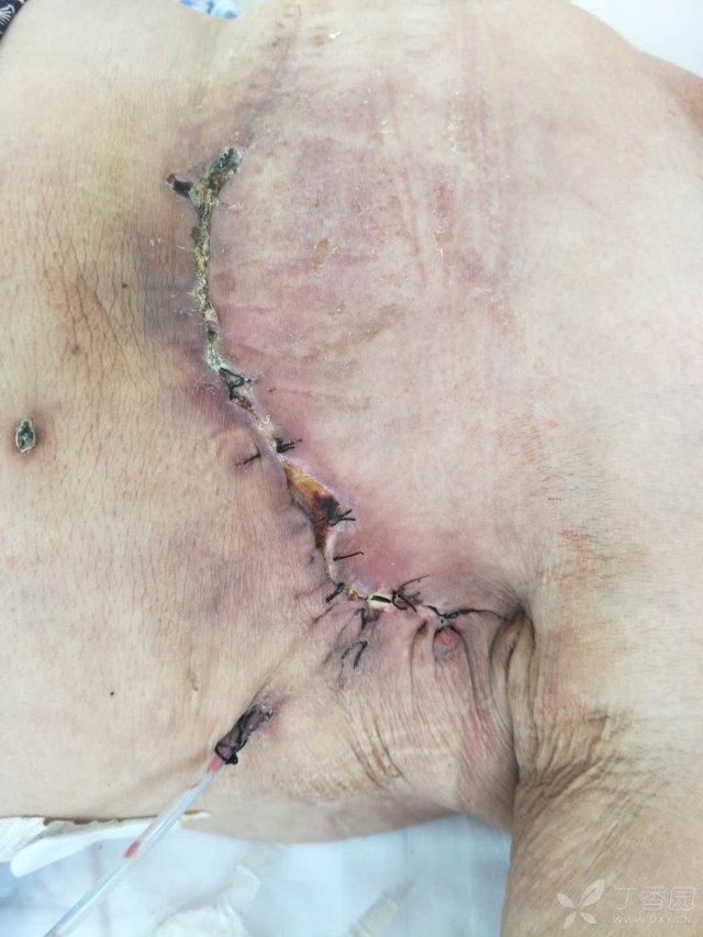 第3次清创切除部分坏死组织后