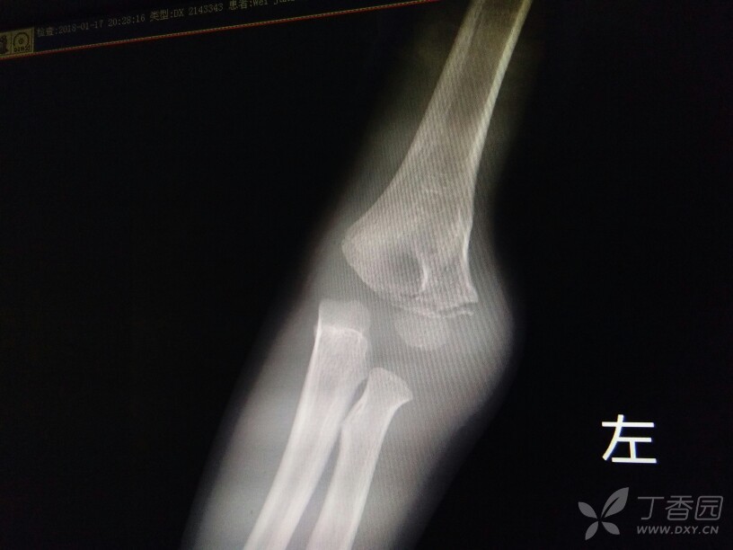 肱骨外髁的治疗 保守还是手术 为什么 骨科专业讨论版 丁香园论坛 肱骨外髁的治疗 保守还是手术 为什么 骨科专业讨论版 丁香园论坛