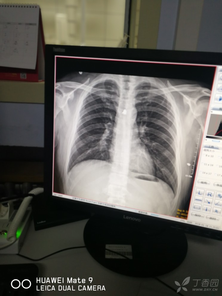 气管炎胸片图片
