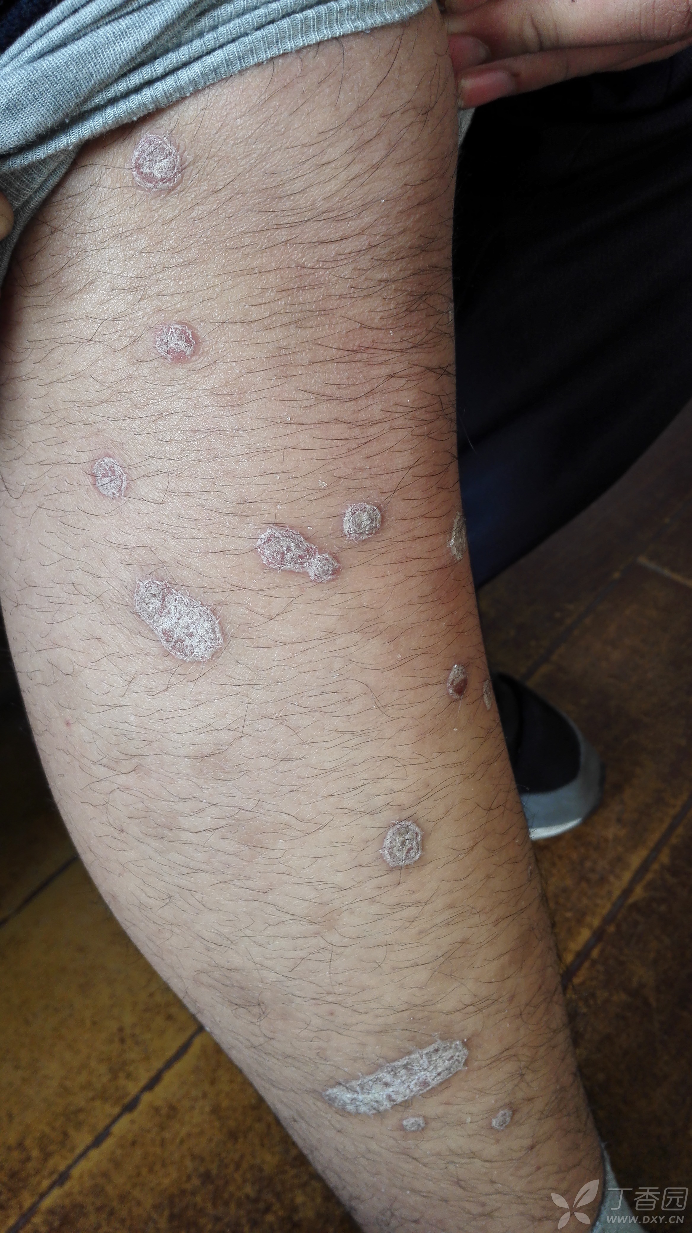 这是银屑病吧 - 皮肤与性传播疾病讨论版 -丁香园论坛