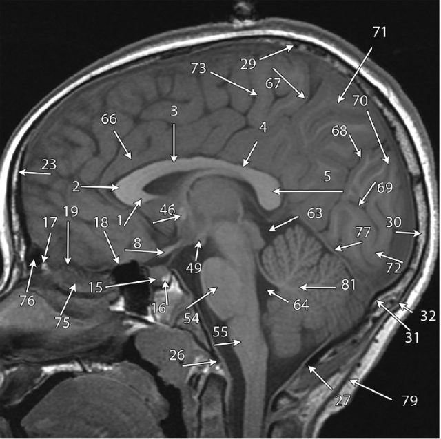 10,鼻窦(sinonasal) 具体组成结构及相关结构结构的位置见下表及图1