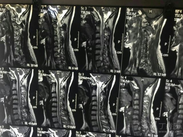 神经科疑难病例讨论:右下肢不自主抖动,什么原
