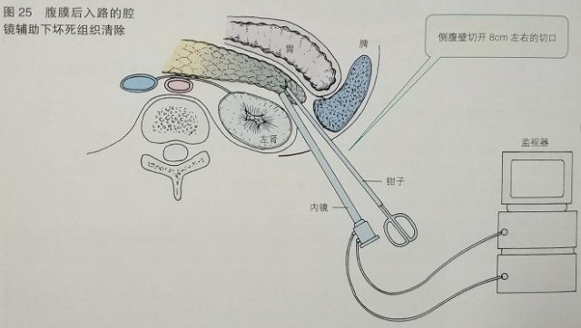 腹腔镜镜结构示意图图片