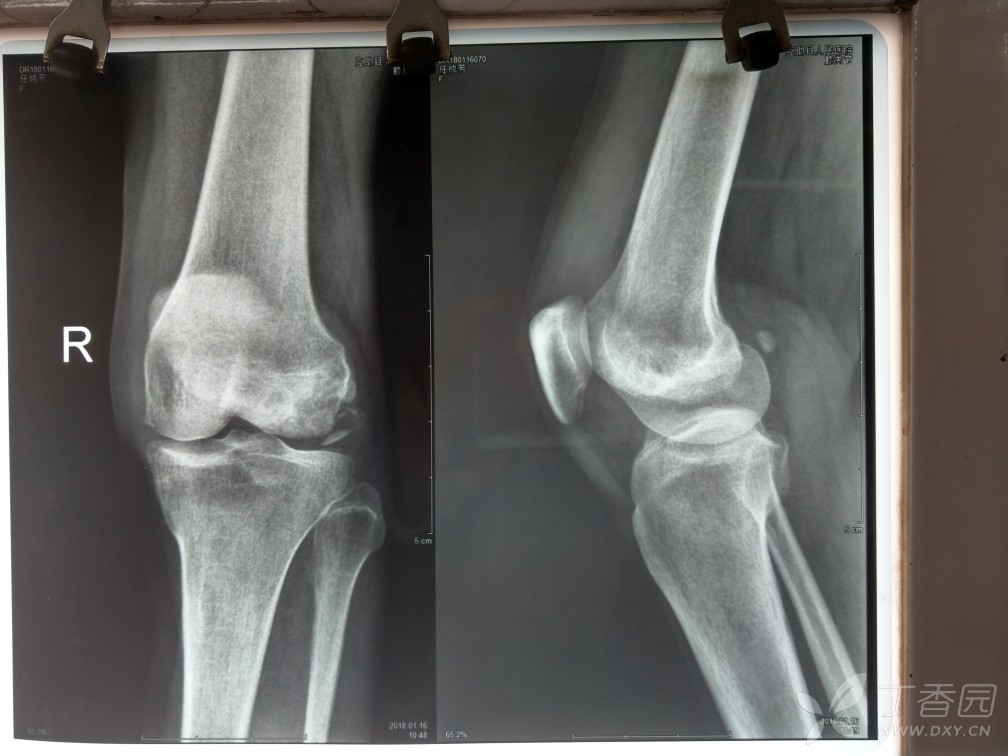 hoffa骨折? - 骨科专业讨论版 -丁香园论坛