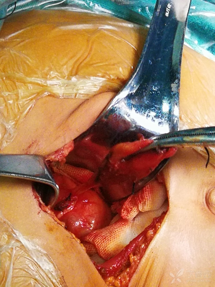 一岁cbd根治术! - 普通外科讨论版 -丁香园论坛