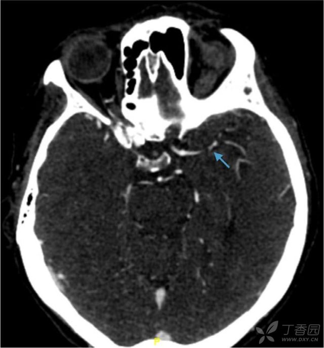 脑梗死怎么治疗最好 教学病例：脑梗死用了双抗仍复发，该怎么办？