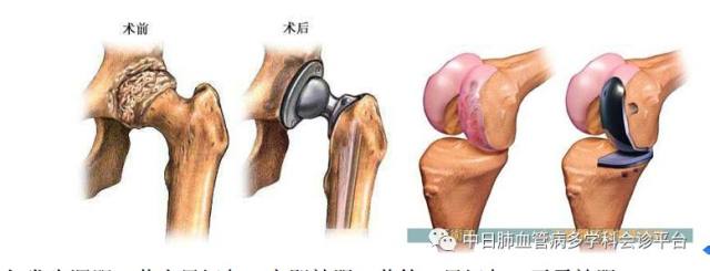 临床药师全程抗凝 临床药师辅导您怎么正确运用抗凝药物之利伐沙班