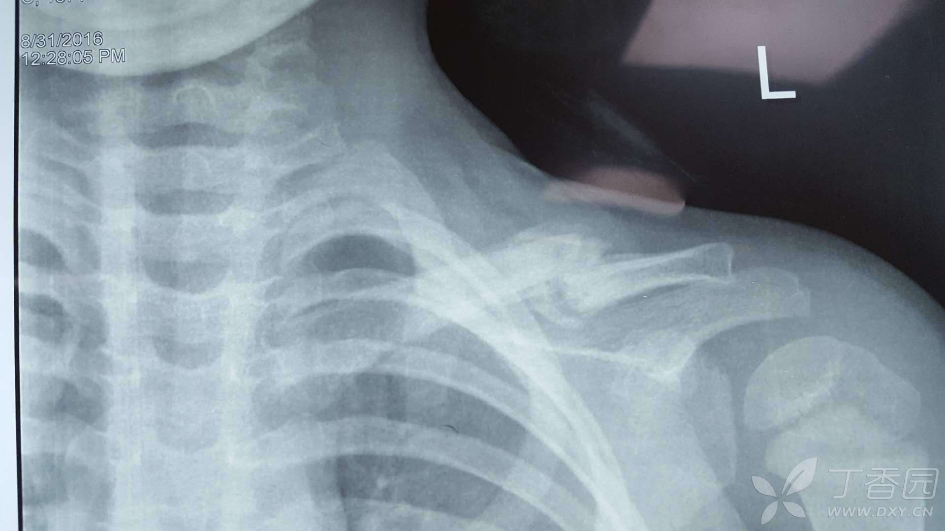锁骨骨折附X光片。求问需不需要手术，保守好还是手术好。_百度知道