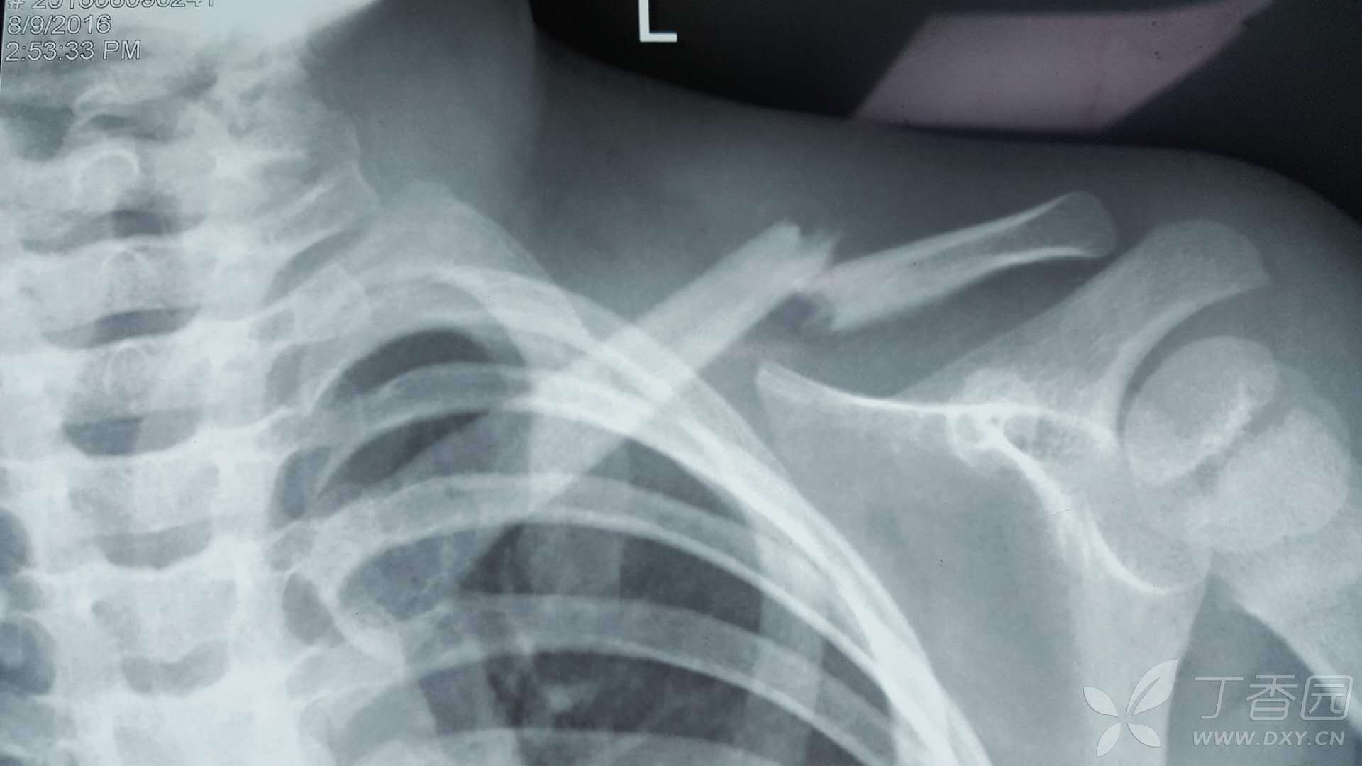 锁骨骨折附X光片。求问需不需要手术，保守好还是手术好。_百度知道