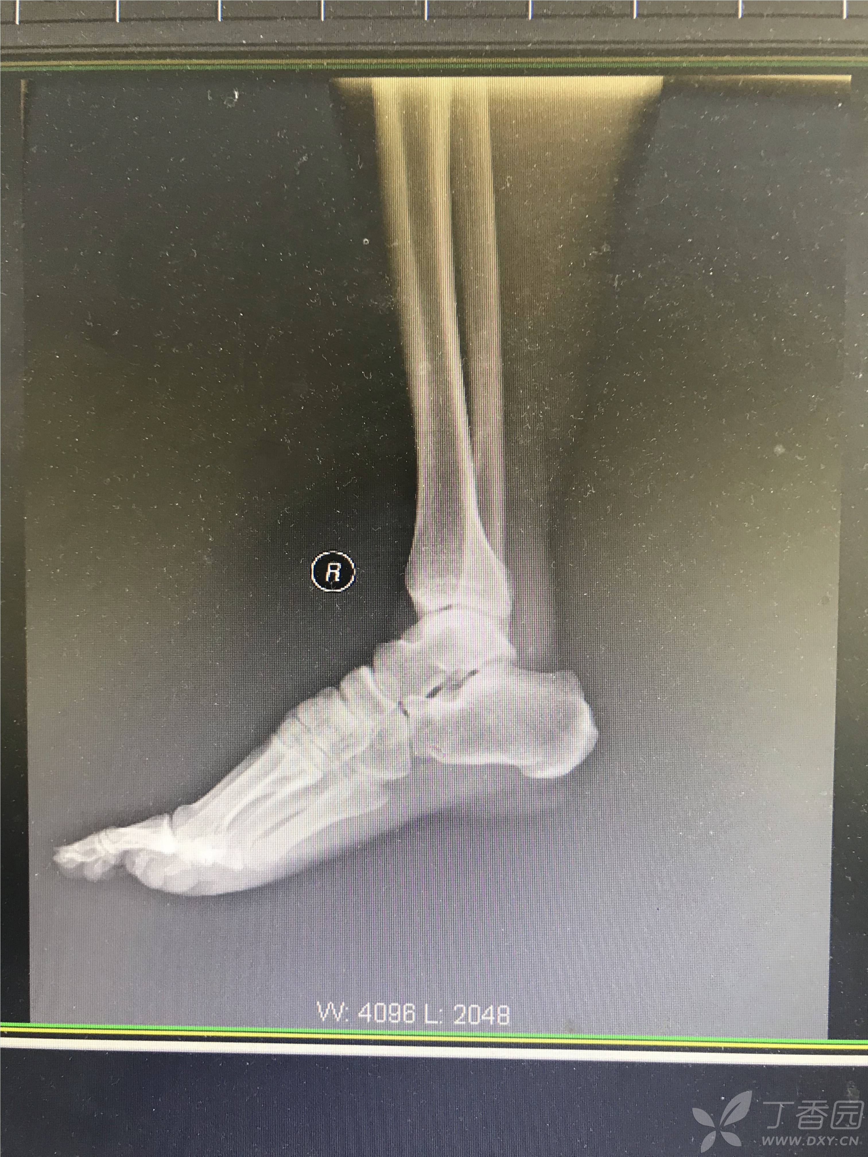 一例罕见的距下关节脱位