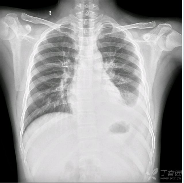 读片挑战:男,13岁,咳嗽,发热,胸痛2天 [病例帖]