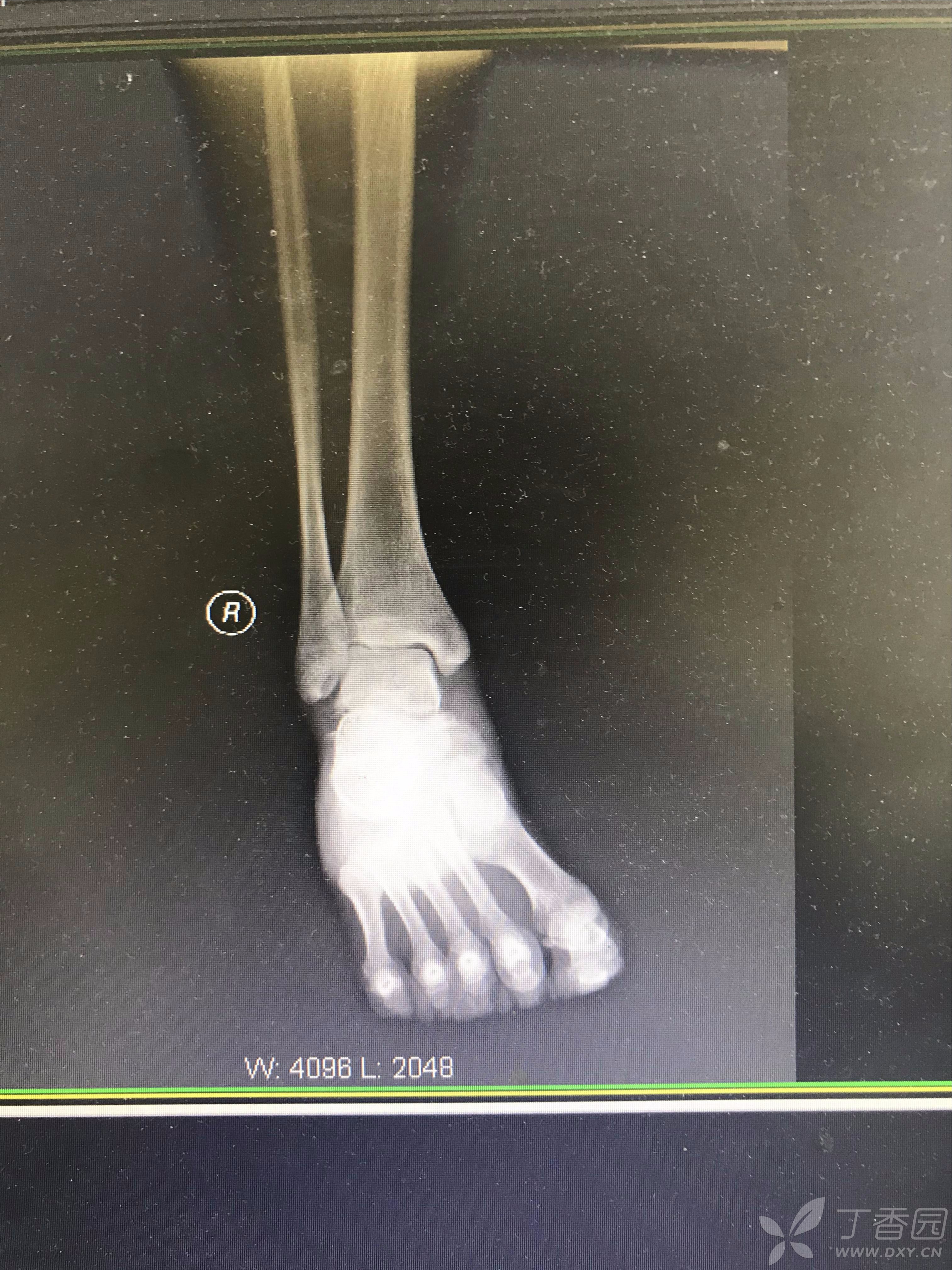 一例罕见的距下关节脱位