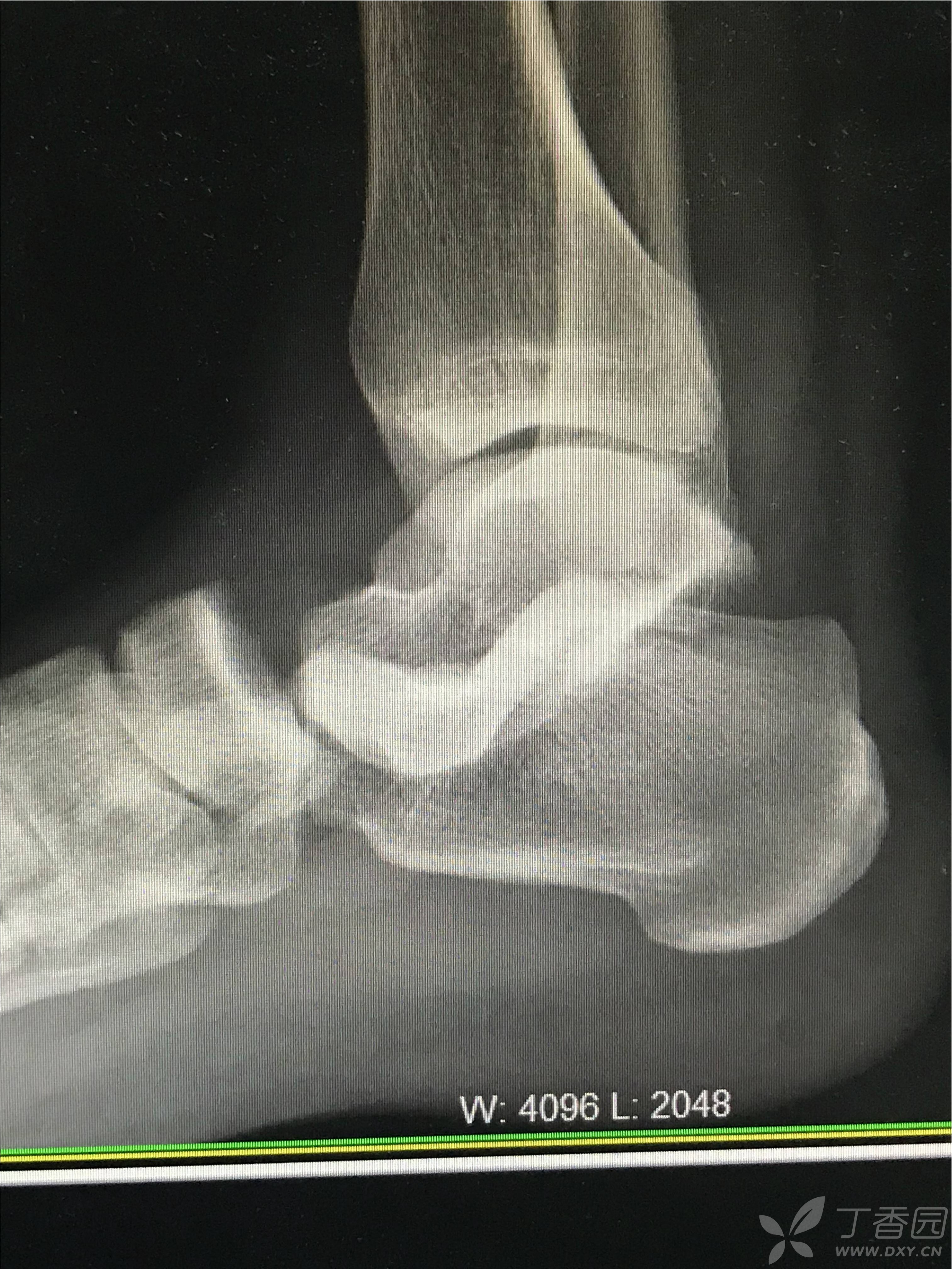 一例罕见的距下关节脱位