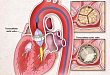 2017 年心脏瓣膜病介入治疗年终盘点
