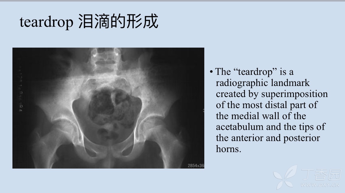 tha术中髋臼假体的放置