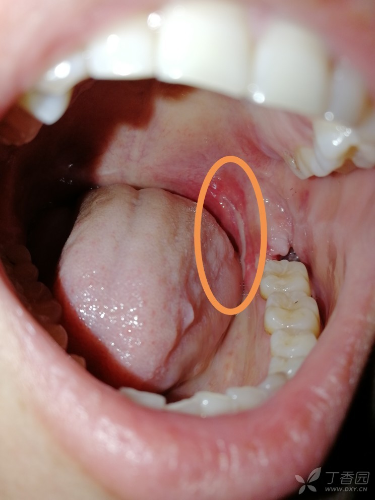 咽腭弓 腭舌弓图片