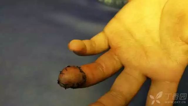 我尽力保全 3 岁女童的手指,让她可以坦然戴上戒指