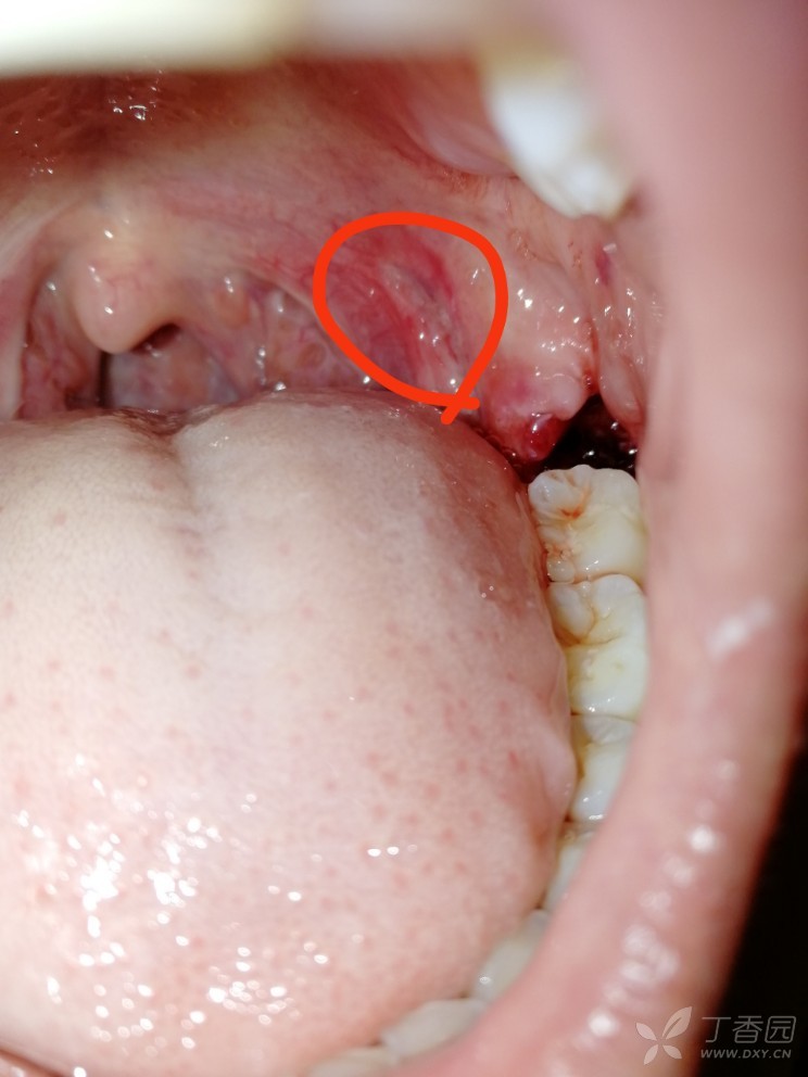 舌腭弓长了一个肉芽图片