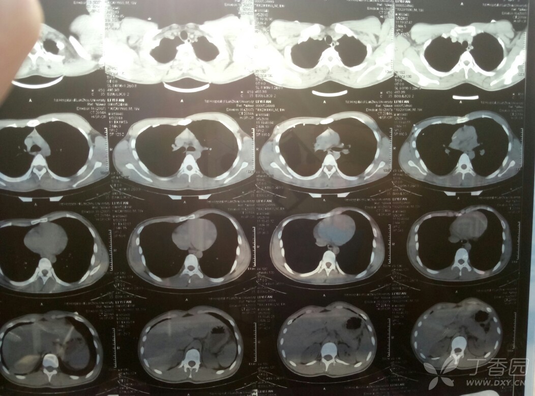 大佬帮忙指导一下肺ct