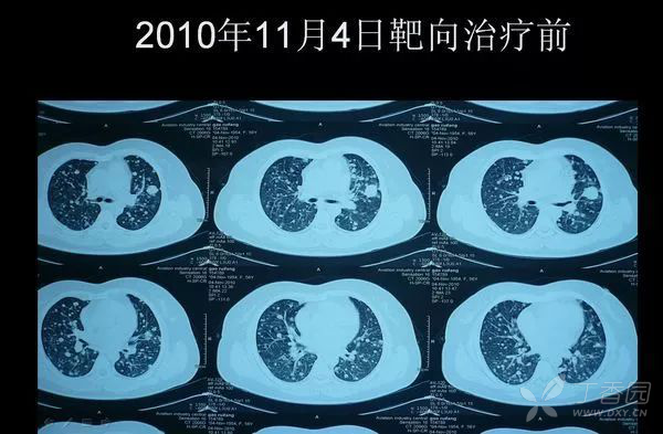 于2010年11月发现左肺癌双肺转移,在北大医院行3次化疗因疗效不佳及不