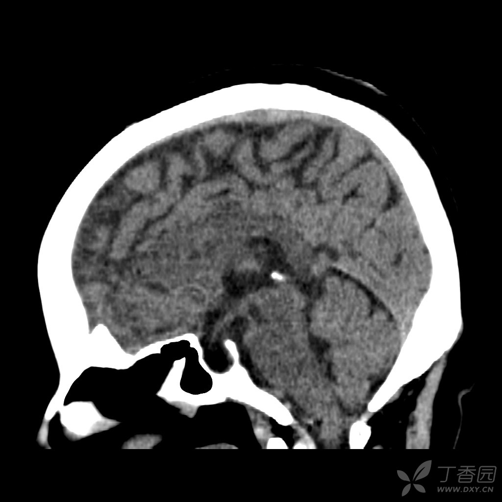 可否诊断空泡蝶鞍？