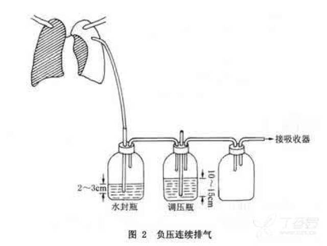 麻醉筆記:雙側肺大泡,氣胸的麻醉處理要點