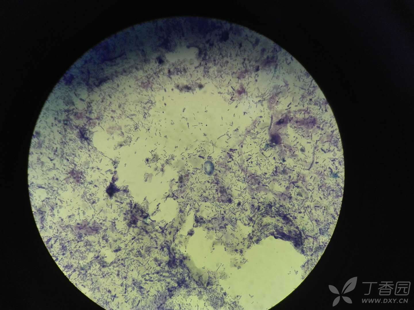 【求助】各位老师,请教下面图片是不是寄生虫包囊,谢谢.