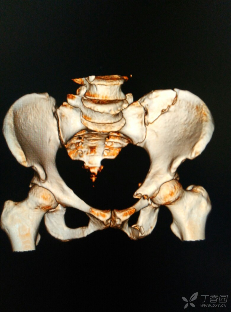 女性骨盆耻骨骨折图片