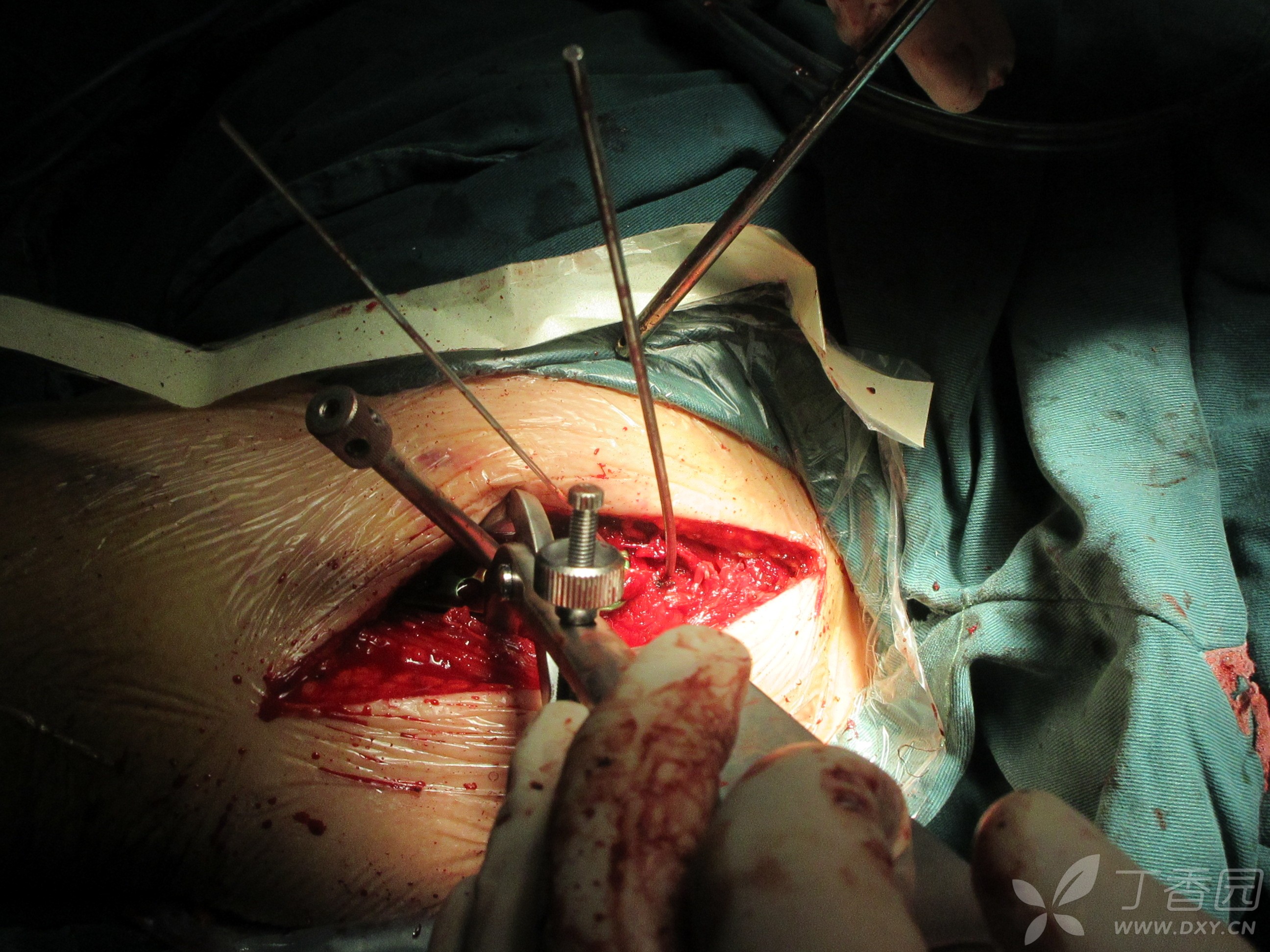 肱骨近端粉碎骨折手术治疗 [病例帖]