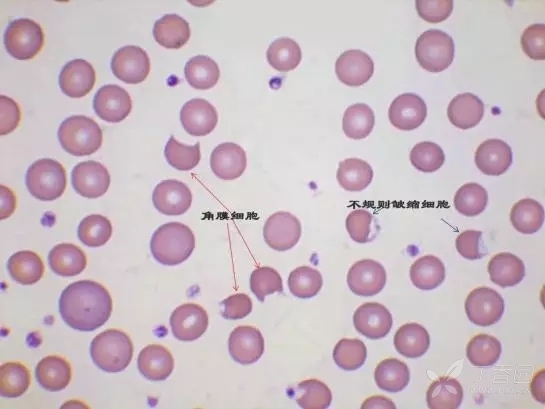 上传张碎裂红细胞的图片加深各位战友的认识,图片来源于网络